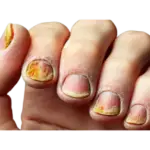 Types of Fingernail Fungus