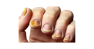 Read more about the article Types of Fingernail Fungus