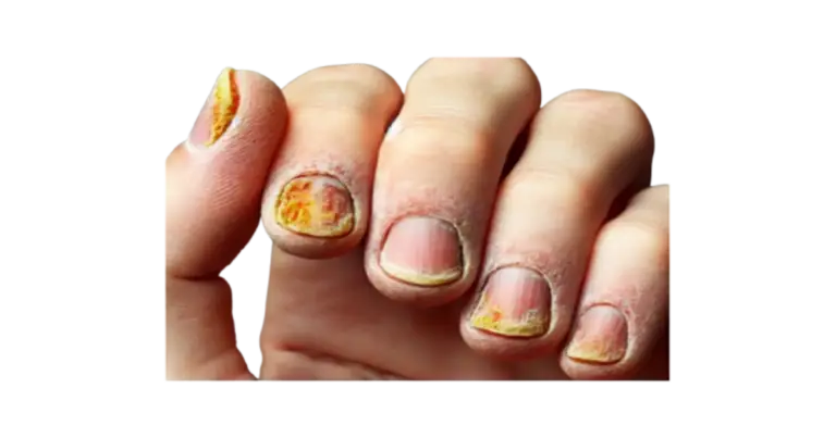 fingernail fungus