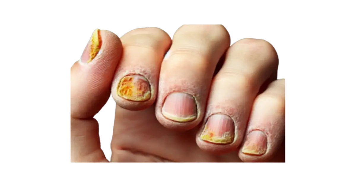 Read more about the article Types of Fingernail Fungus