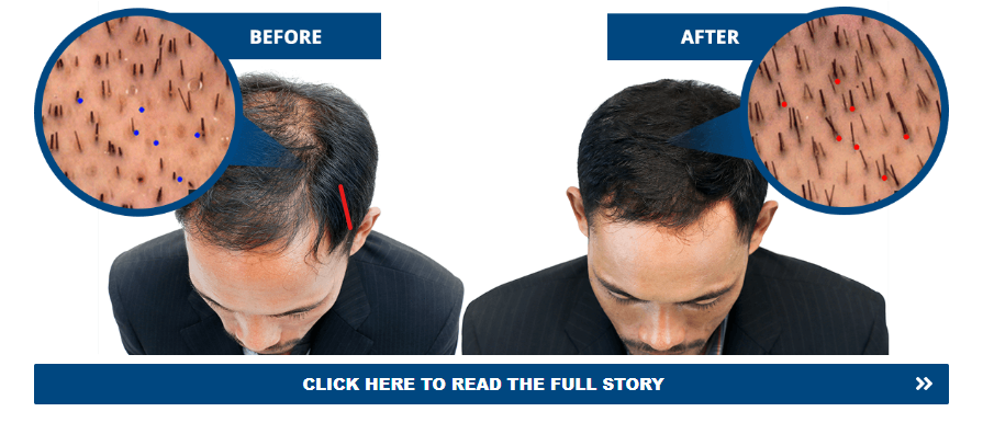 recedind hair line treatment